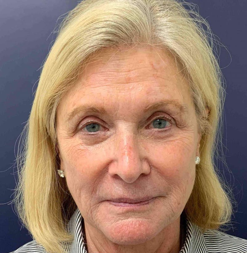 Laser Skin Resurfacing Before & After Gallery - Patient 308038 - Image 1