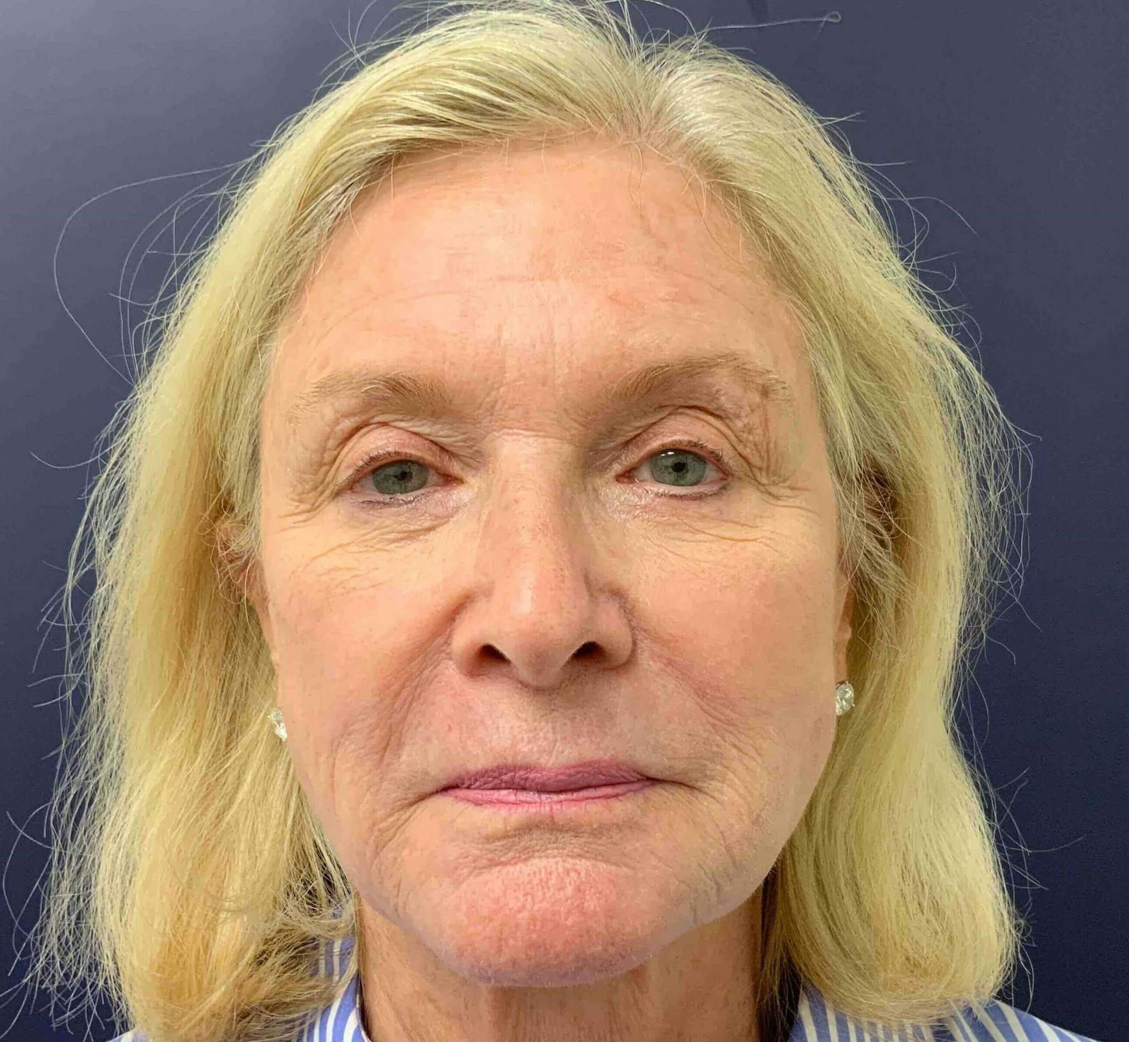 Laser Skin Resurfacing Before & After Gallery - Patient 308038 - Image 2