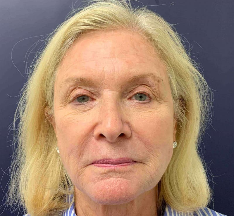 Laser Skin Resurfacing Before & After Gallery - Patient 308038 - Image 2