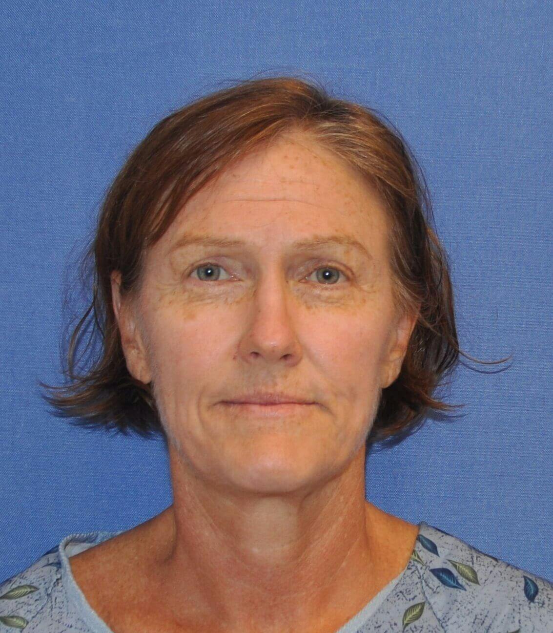 Laser Skin Resurfacing Before & After Gallery - Patient 453174 - Image 1
