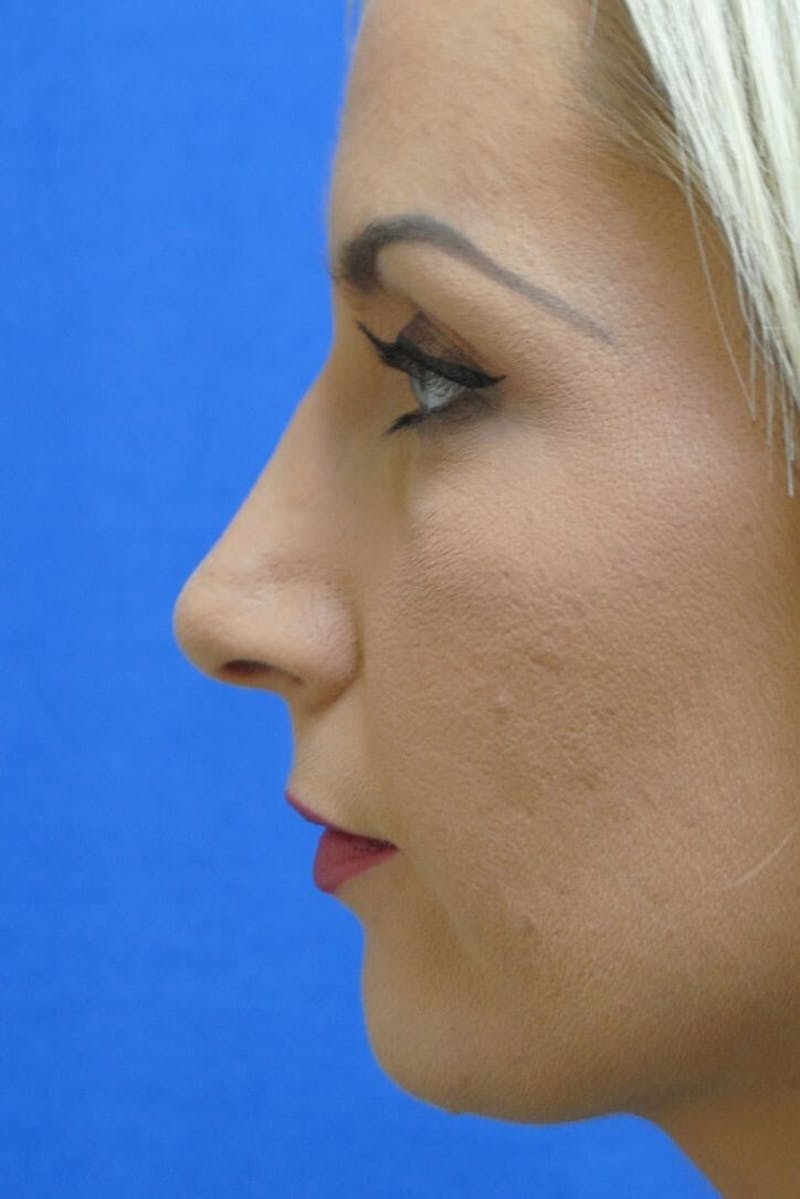 Rhinoplasty Before & After Gallery - Patient 799371 - Image 2