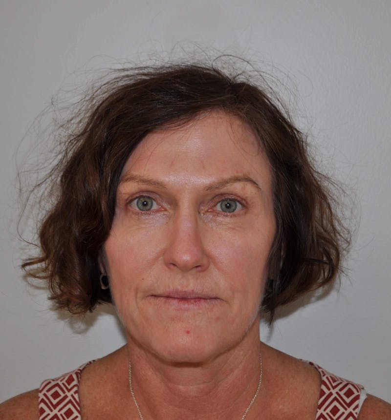 Laser Skin Resurfacing Before & After Gallery - Patient 453174 - Image 2