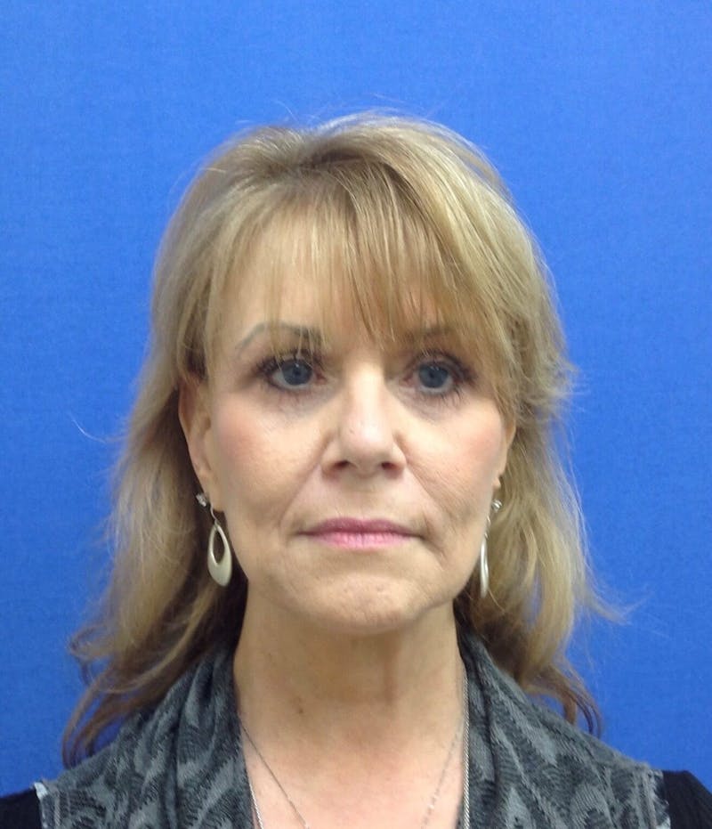 Neck Lift Before & After Gallery - Patient 494081 - Image 2