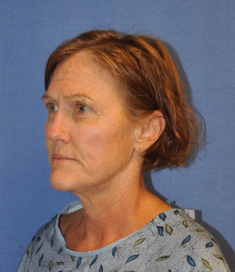 Laser Skin Resurfacing Before & After Gallery - Patient 453174 - Image 3
