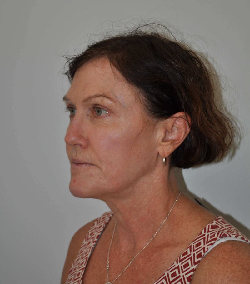 Laser Skin Resurfacing Before & After Gallery - Patient 453174 - Image 4