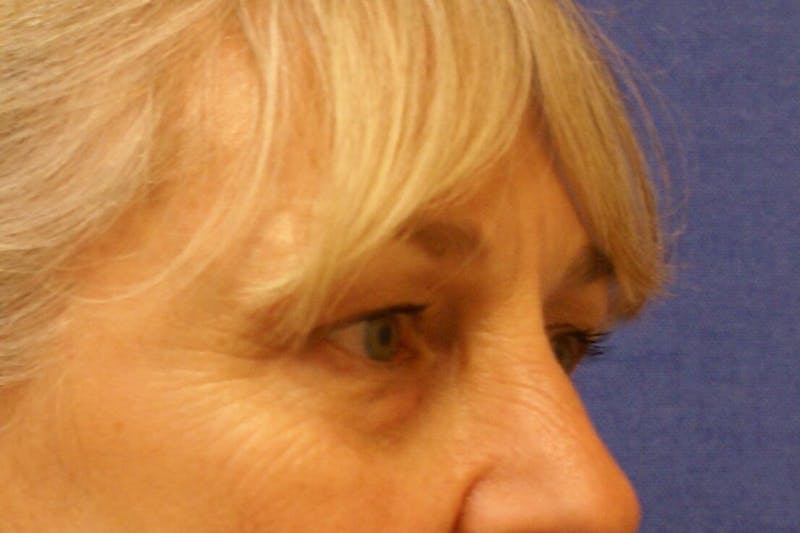 Eyelid Surgery Before & After Gallery - Patient 329301 - Image 3