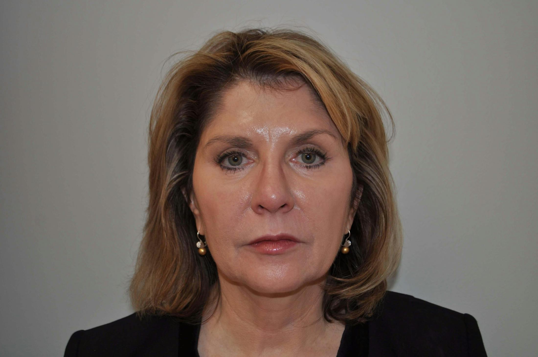 Laser Skin Resurfacing Before & After Gallery - Patient 102911 - Image 2