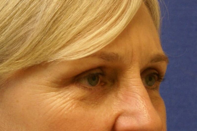 Eyelid Surgery Before & After Gallery - Patient 329301 - Image 4