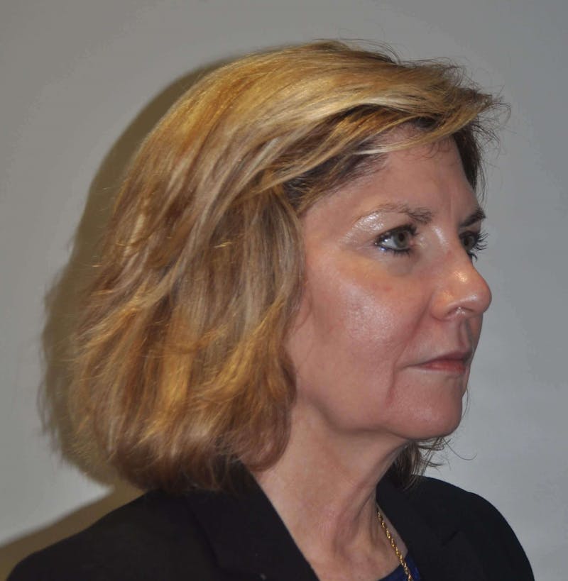Laser Skin Resurfacing Before & After Gallery - Patient 102911 - Image 3