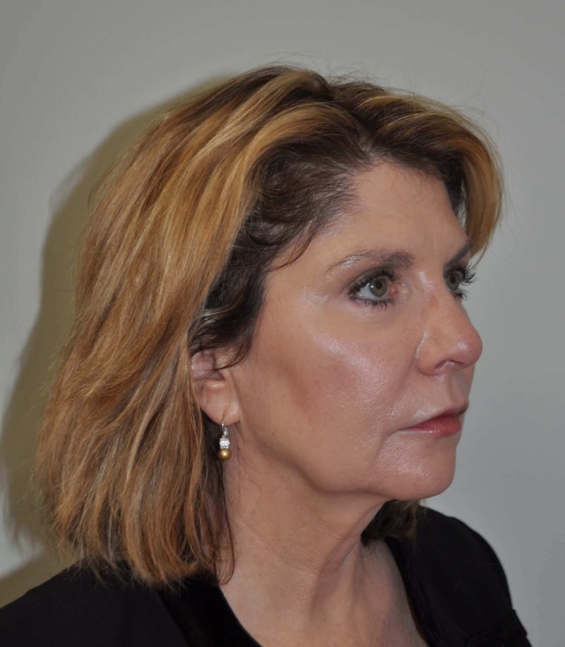 Laser Skin Resurfacing Before & After Gallery - Patient 102911 - Image 4