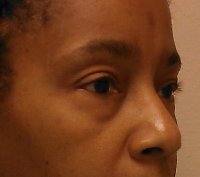 Eyelid Surgery Before & After Gallery - Patient 153696 - Image 3