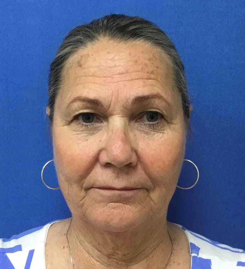 Laser Skin Resurfacing Before & After Gallery - Patient 303898 - Image 1