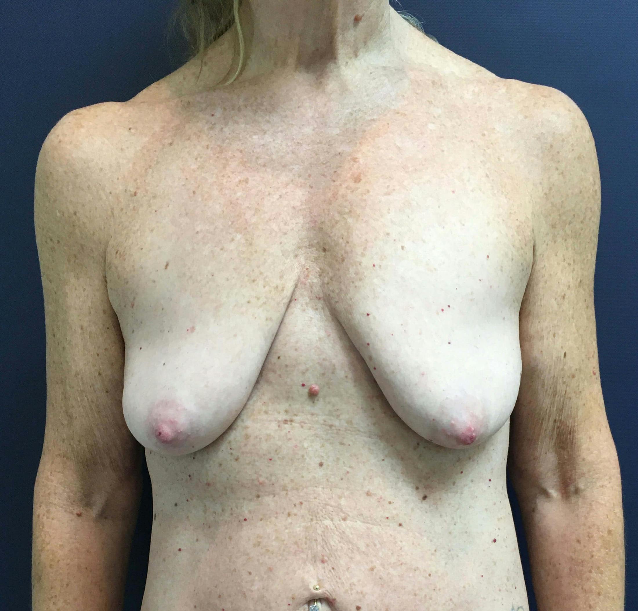 Breast Lift (Mastopexy) Before & After Gallery - Patient 127392 - Image 1