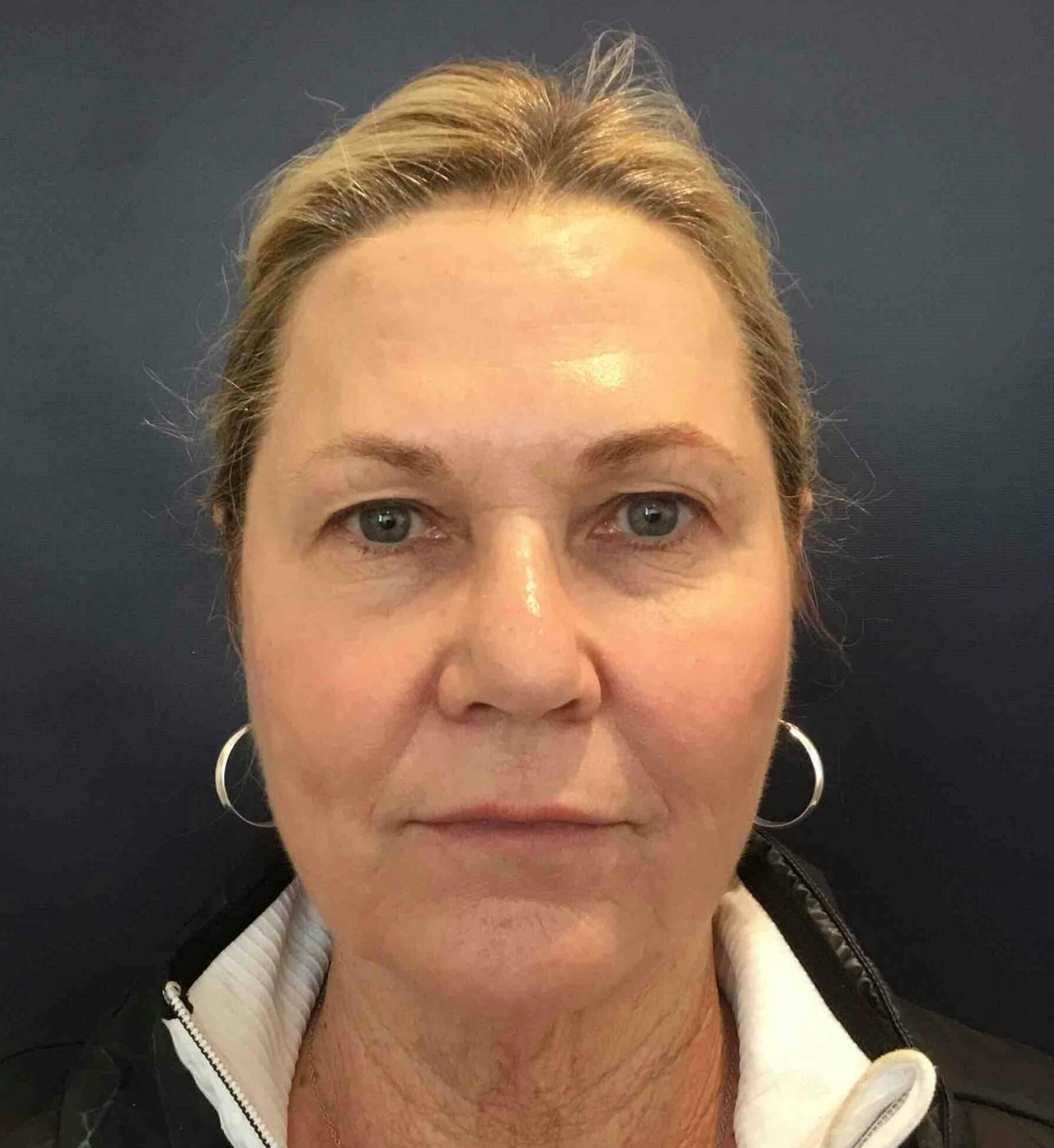 Laser Skin Resurfacing Before & After Gallery - Patient 303898 - Image 2