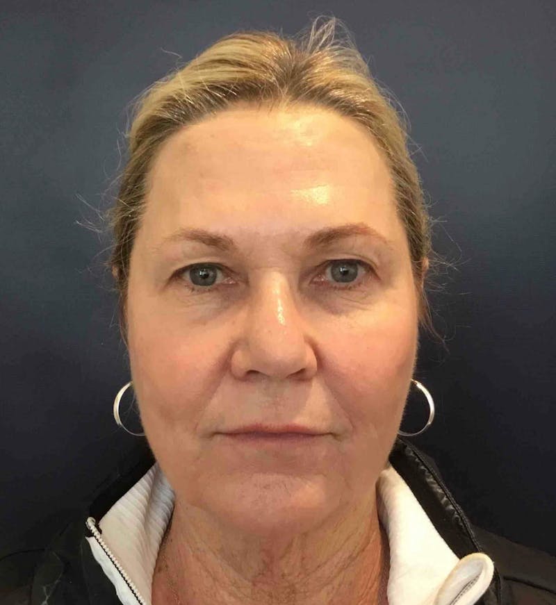 Laser Skin Resurfacing Before & After Gallery - Patient 303898 - Image 2