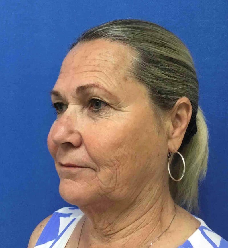 Laser Skin Resurfacing Before & After Gallery - Patient 303898 - Image 3