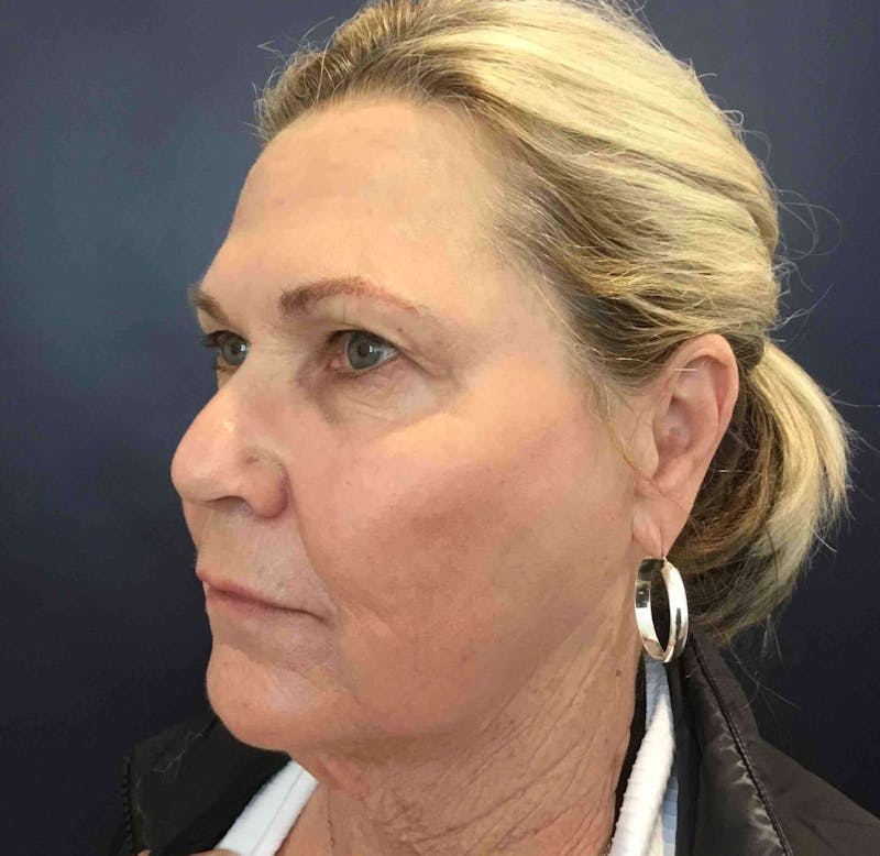 Laser Skin Resurfacing Before & After Gallery - Patient 303898 - Image 4