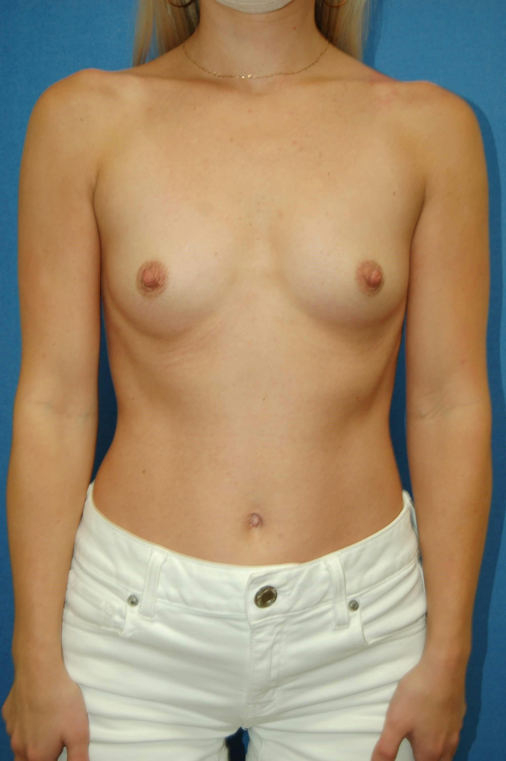 Breast Augmentation Before & After Gallery - Patient 377730 - Image 1