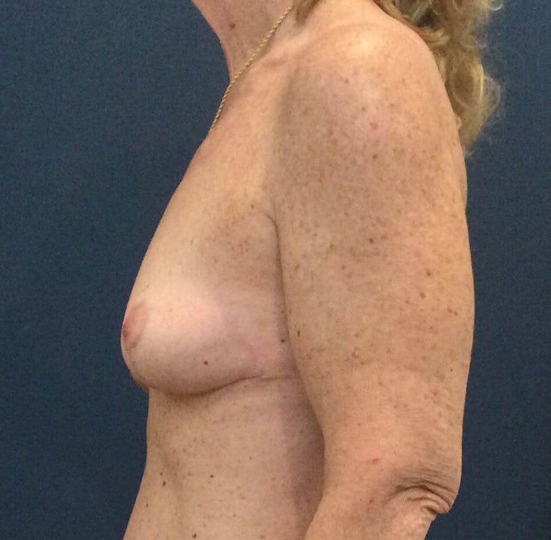 Breast Lift (Mastopexy) Before & After Gallery - Patient 127392 - Image 4