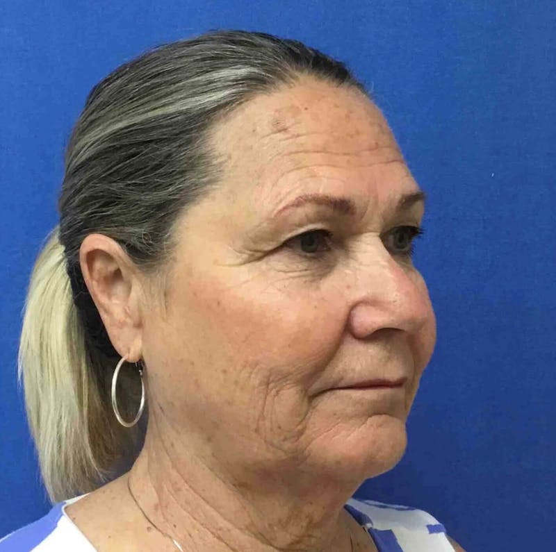 Laser Skin Resurfacing Before & After Gallery - Patient 303898 - Image 5