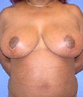 Breast Reduction Before & After Gallery - Patient 168933 - Image 2