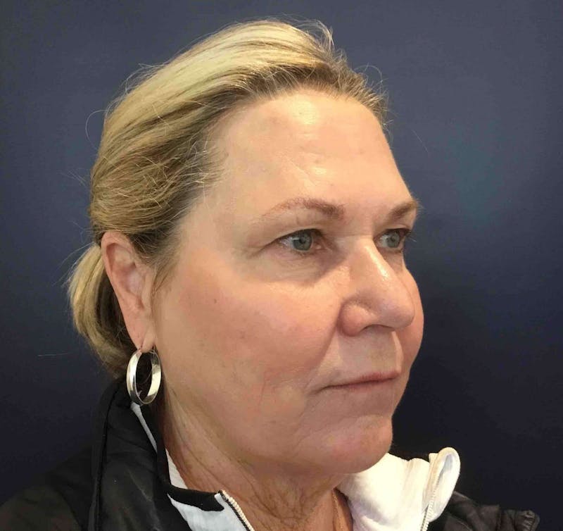 Laser Skin Resurfacing Before & After Gallery - Patient 303898 - Image 6