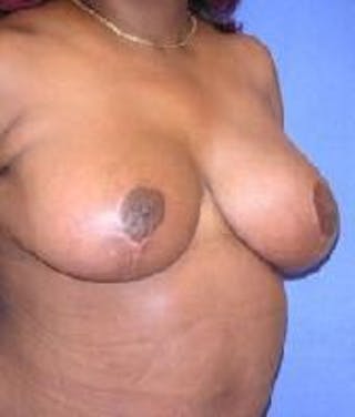 Breast Reduction Before & After Gallery - Patient 168933 - Image 4