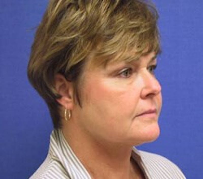Neck Liposuction Before & After Gallery - Patient 280425 - Image 2