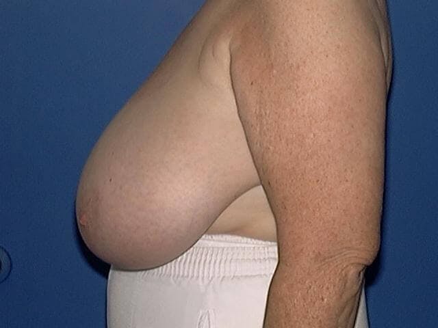 Breast Reduction Before & After Gallery - Patient 231819 - Image 1