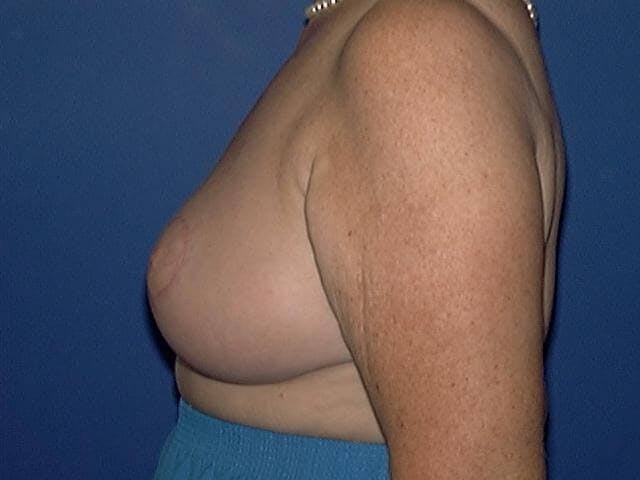 Breast Reduction Before & After Gallery - Patient 231819 - Image 2