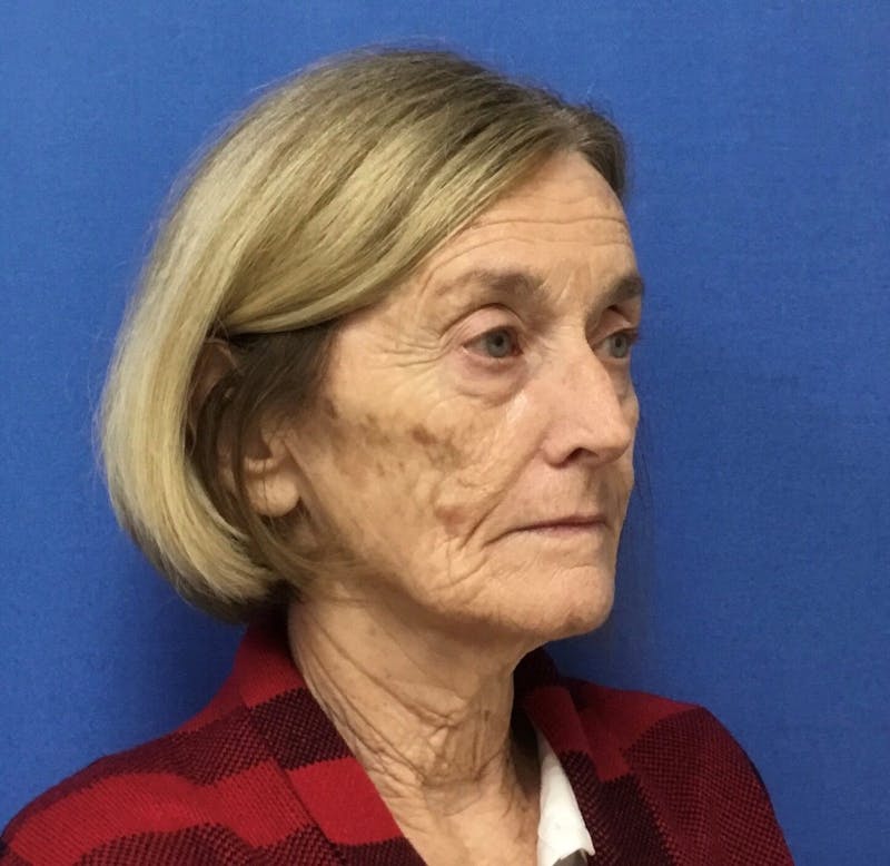 Laser Skin Resurfacing Before & After Gallery - Patient 226068 - Image 3