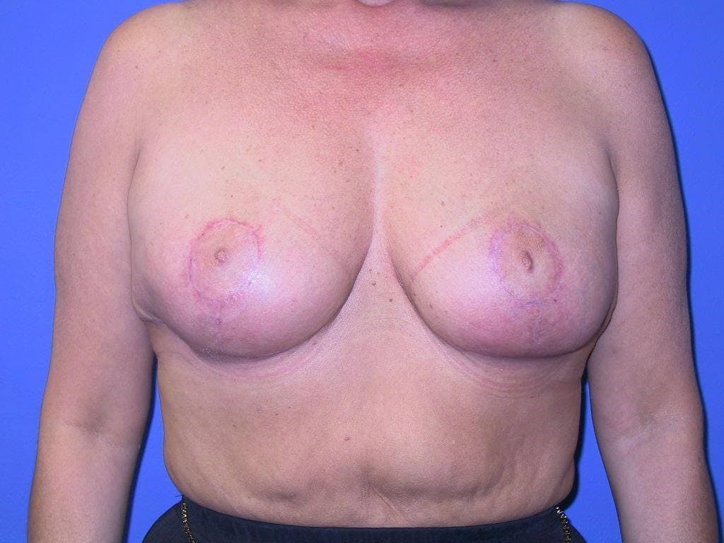 Breast Reduction Before & After Gallery - Patient 289614 - Image 2