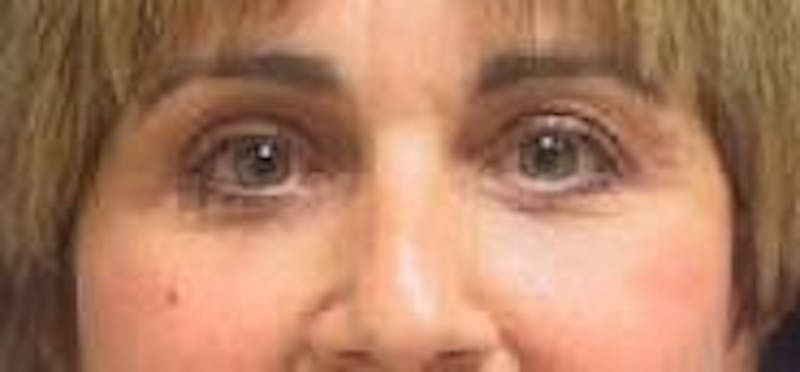 Eyelid Surgery Before & After Gallery - Patient 144005 - Image 2