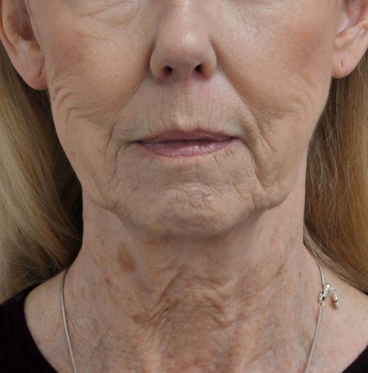 Neck Lift Before & After Gallery - Patient 152739 - Image 1