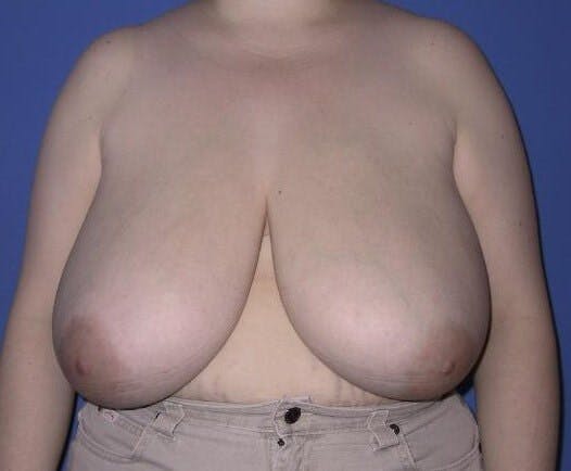 Breast Reduction Before & After Gallery - Patient 774456 - Image 1