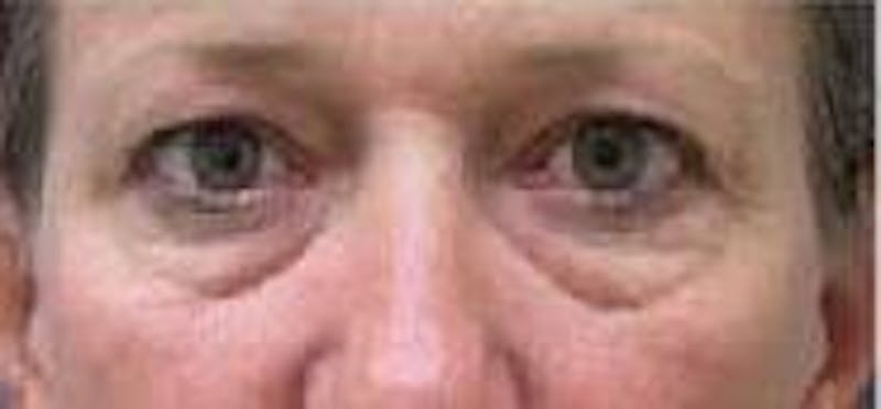 Eyelid Surgery Before & After Gallery - Patient 368278 - Image 1