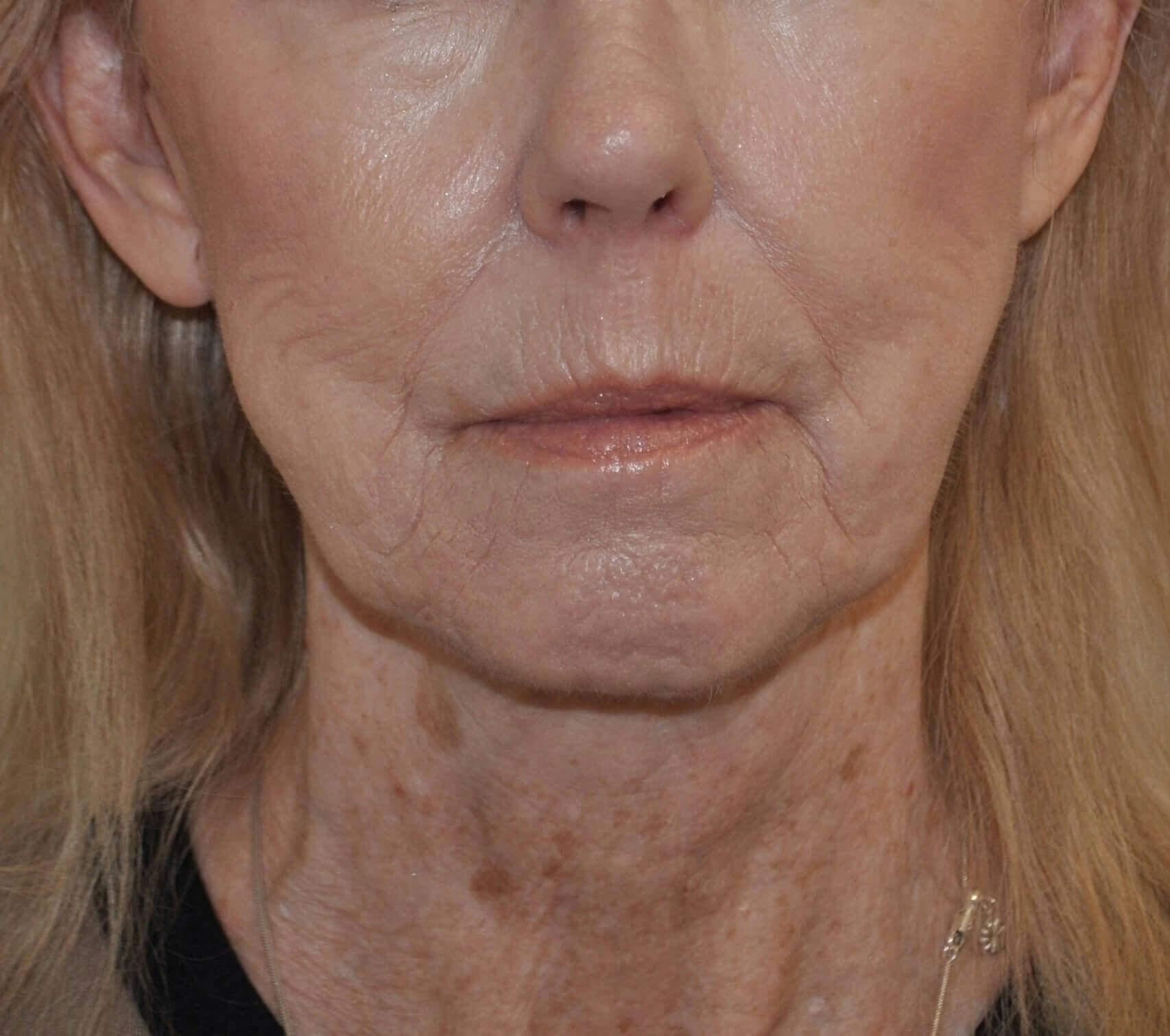 Neck Lift Before & After Gallery - Patient 152739 - Image 2