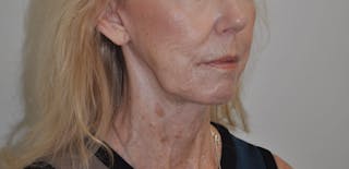 Neck Lift Before & After Gallery - Patient 152739 - Image 4