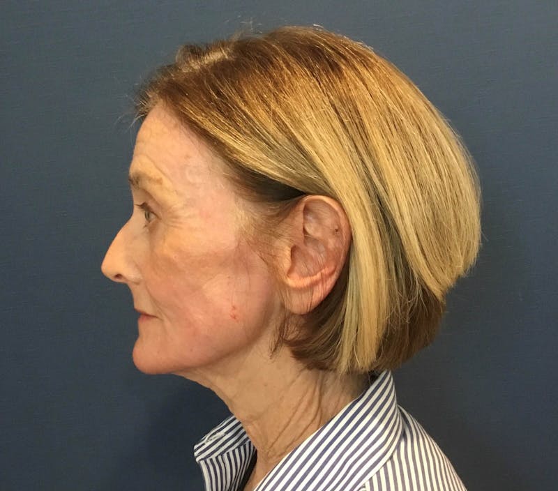 Laser Skin Resurfacing Before & After Gallery - Patient 226068 - Image 10