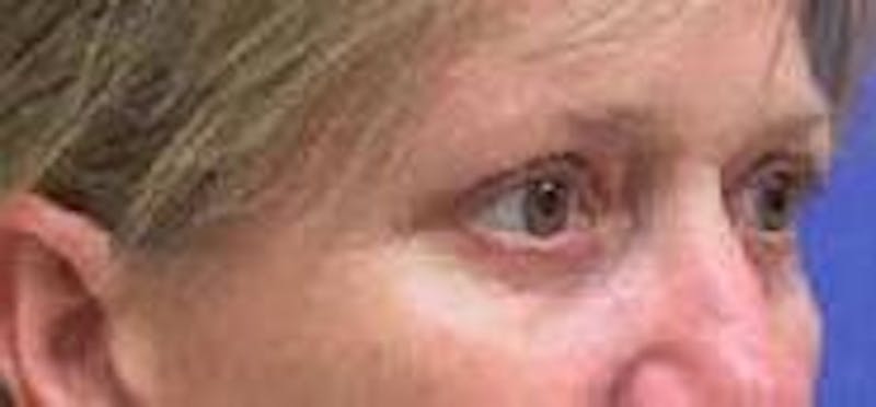 Eyelid Surgery Before & After Gallery - Patient 368278 - Image 4