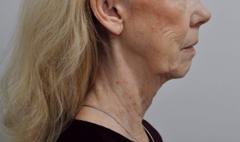 Neck Lift Before & After Gallery - Patient 152739 - Image 5
