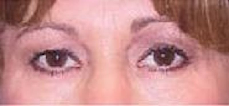 Eyelid Surgery Before & After Gallery - Patient 147043 - Image 1