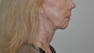 Neck Lift Before & After Gallery - Patient 152739 - Image 6