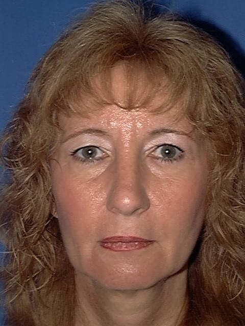 Neck Lift Before & After Gallery - Patient 336450 - Image 1