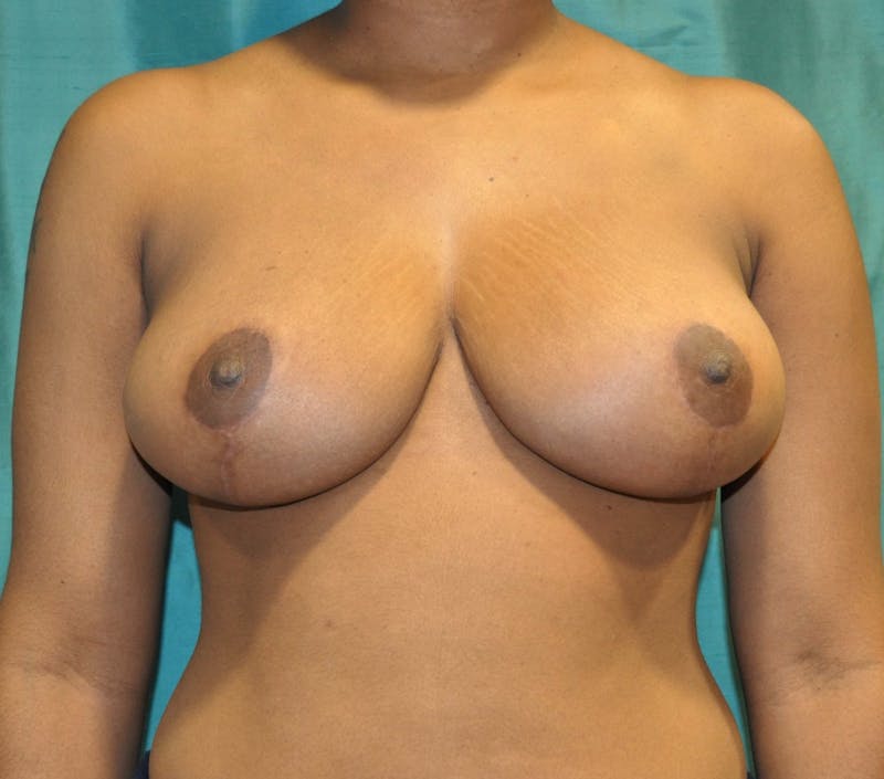 Breast Reduction Before & After Gallery - Patient 296330 - Image 2