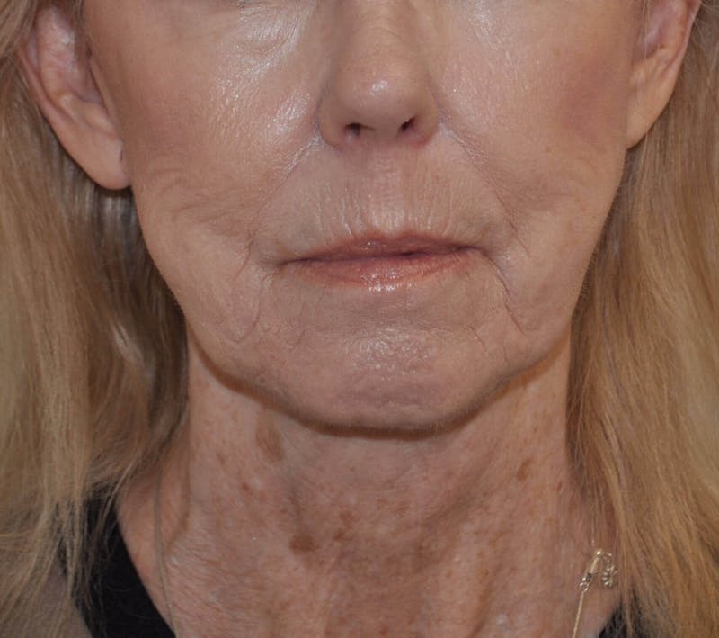 Laser Skin Resurfacing Before & After Gallery - Patient 462837 - Image 2