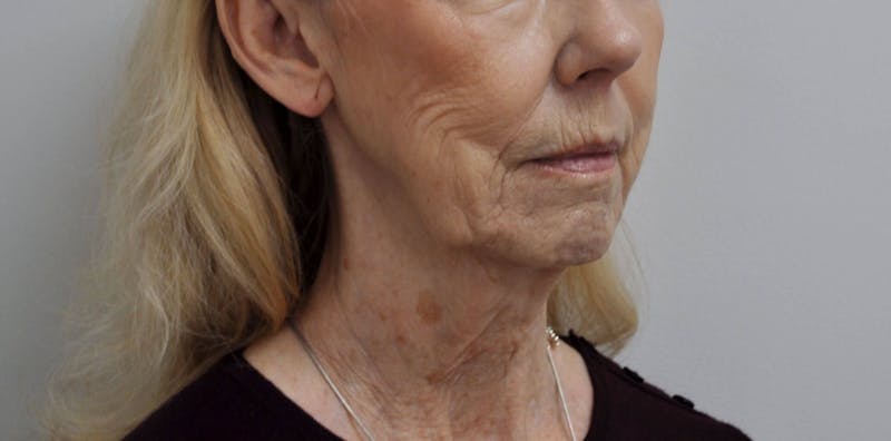 Laser Skin Resurfacing Before & After Gallery - Patient 462837 - Image 3