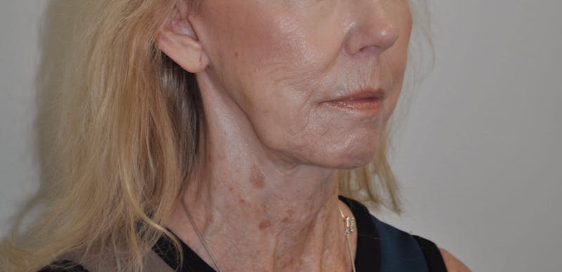 Laser Skin Resurfacing Before & After Gallery - Patient 462837 - Image 4