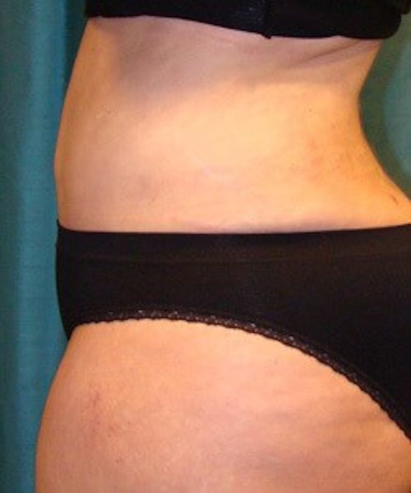 Tummy Tuck Before & After Gallery - Patient 215910 - Image 6