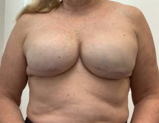 Breast Reconstruction Before & After Gallery - Patient 378044 - Image 2